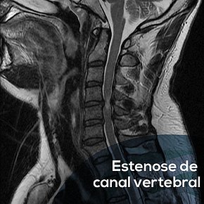 Estenose de canal vertebral