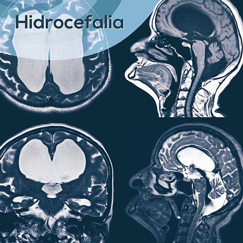 Hidrocefalia